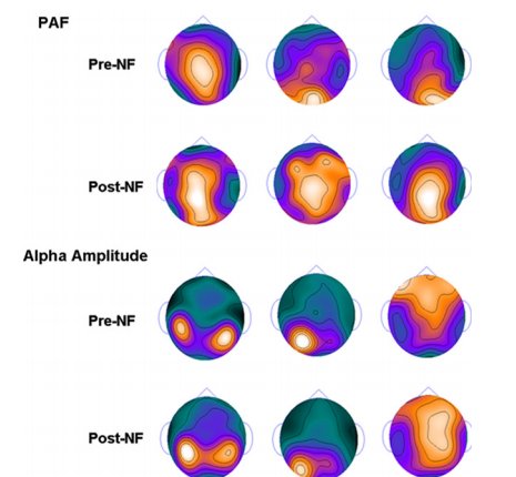 نوروفیدبک (NF) الکتروانسفالوگرافی (EEG): نمونه آموزش اوج فرکانس آلفا